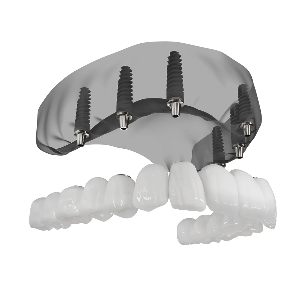 A 3D illustration of a full arch implant being placed.
