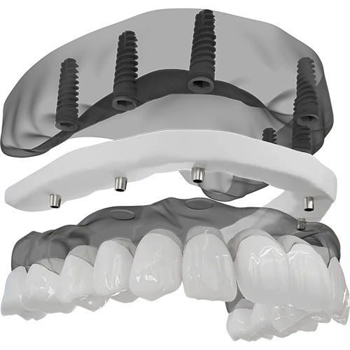 A 3D illustration of a full arch implant being placed.