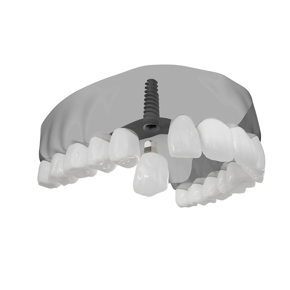 A 3D illustration of an implant being placed.