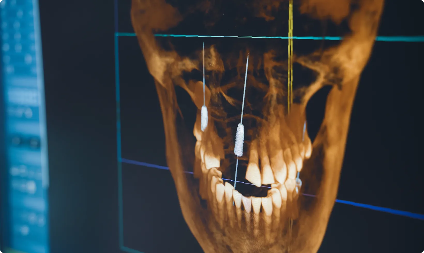 CT scan of implants.