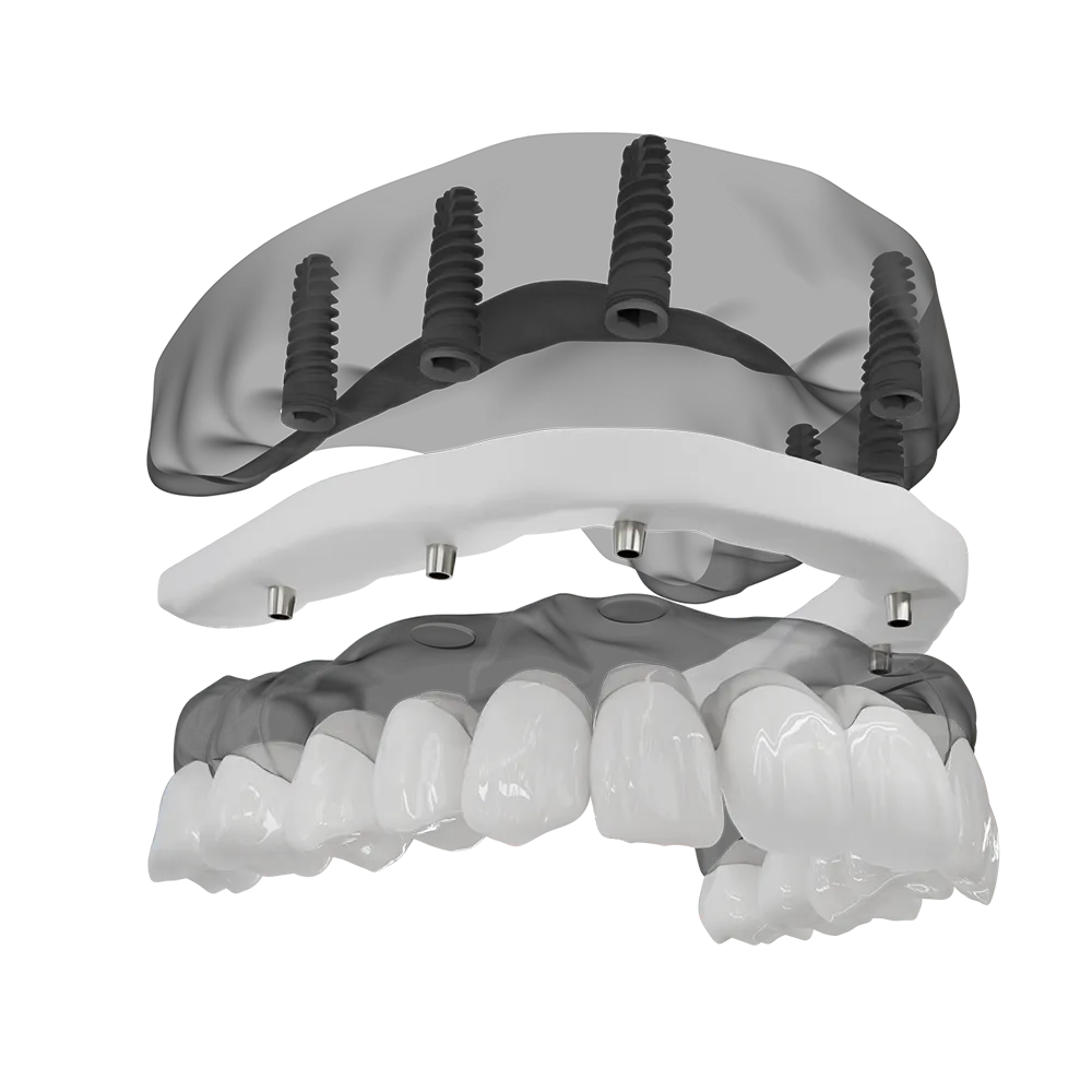 A 3D illustration of a full arch implant being placed.