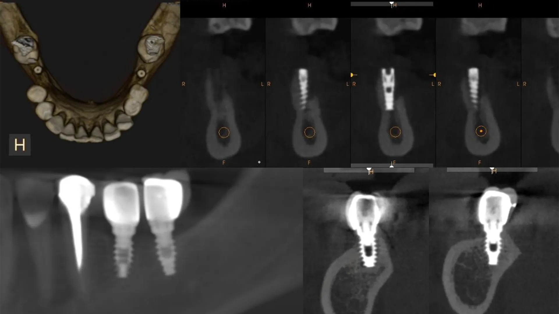 CT scan of implants.