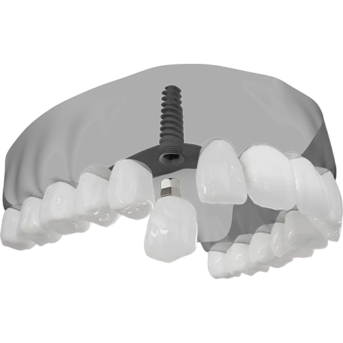 A 3D illustration of an implant being placed.