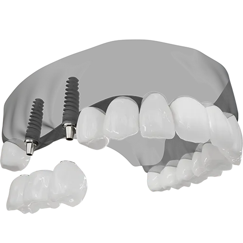 Implant Bridge