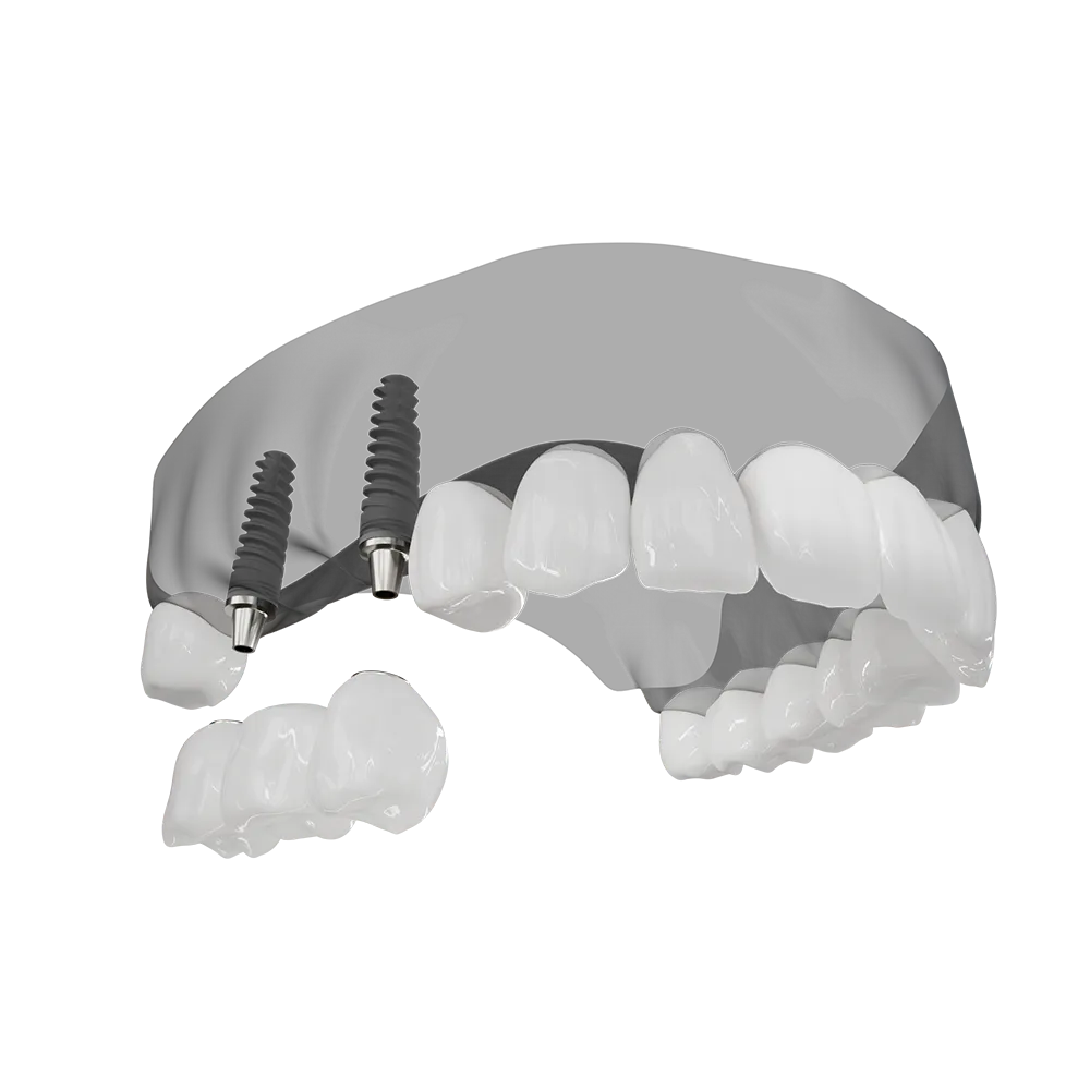 A 3D illustration of an implant supported bridge being placed.