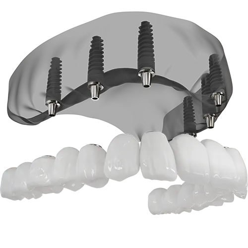 A 3D illustration of a full arch implant being placed.