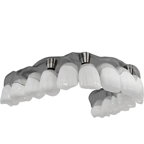 A 3D illustration of an implant supported denture being placed.