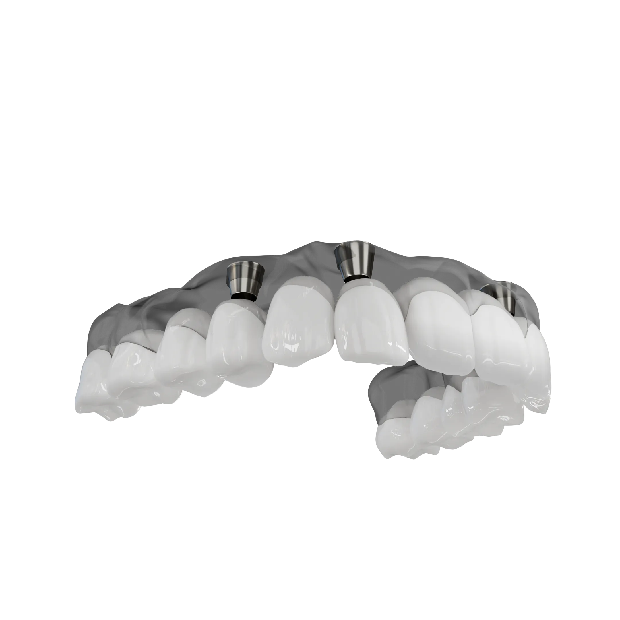 A 3D illustration of an implant supported denture being placed.