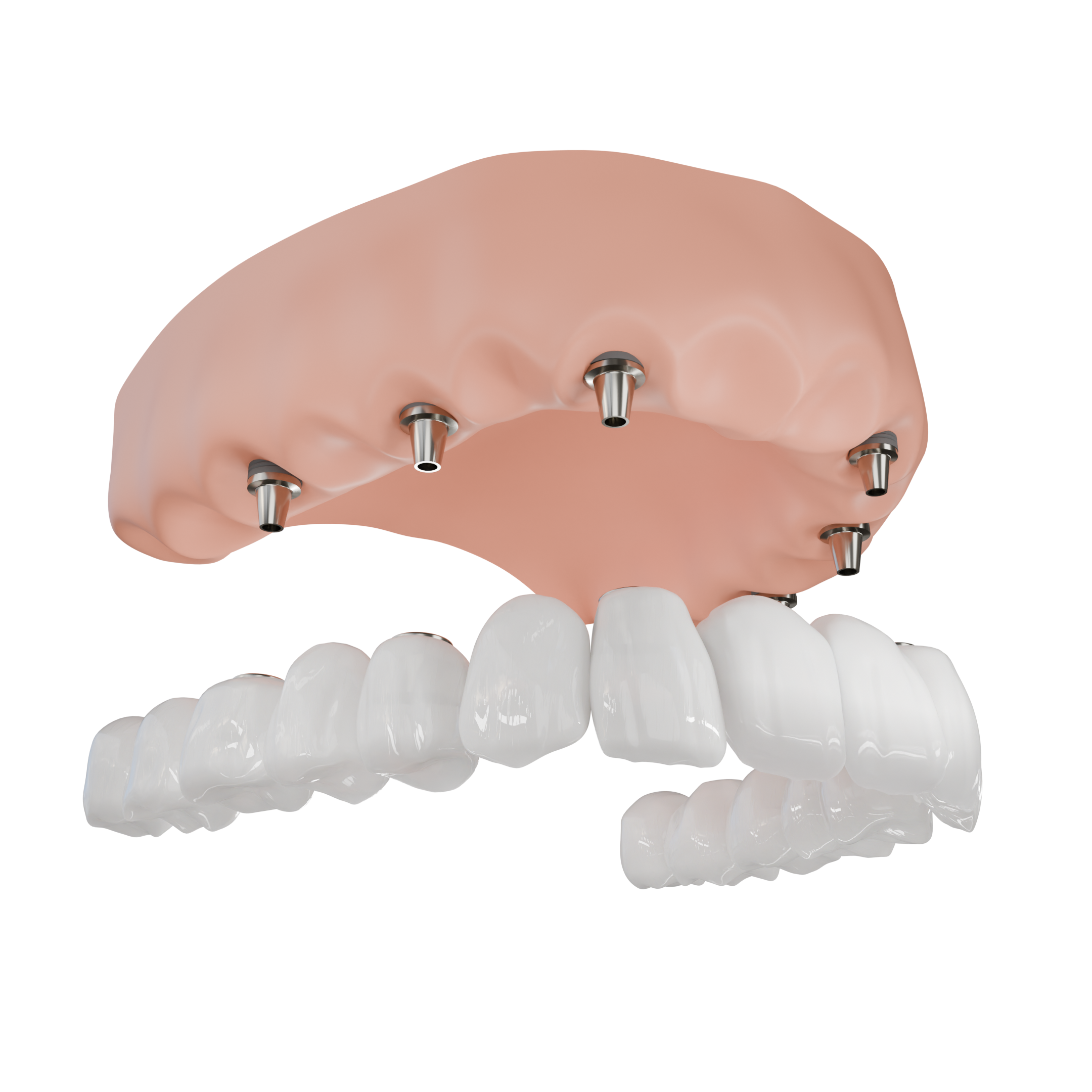 Full Arch Reconstruction - Front View