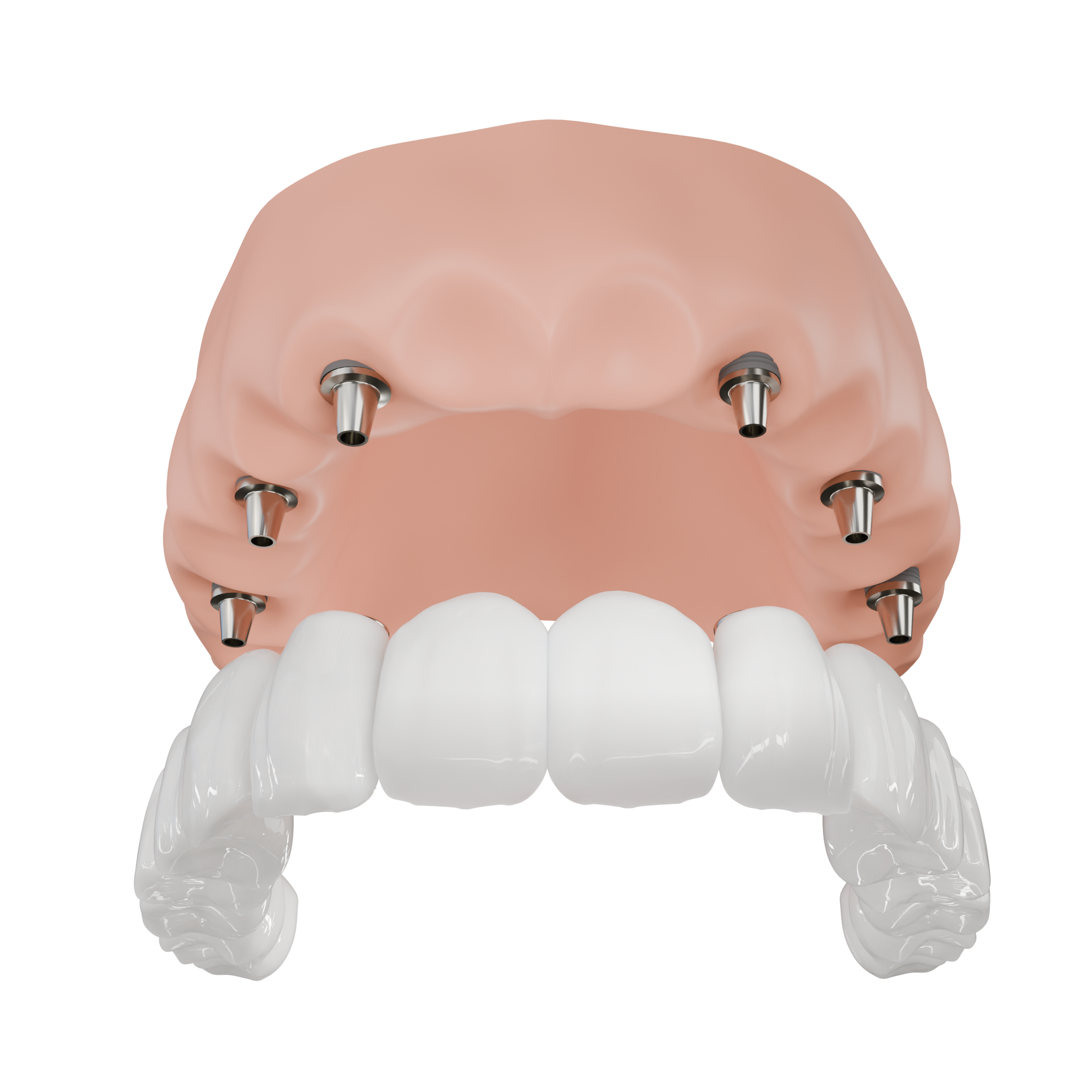 Full Arch Reconstruction - Side View