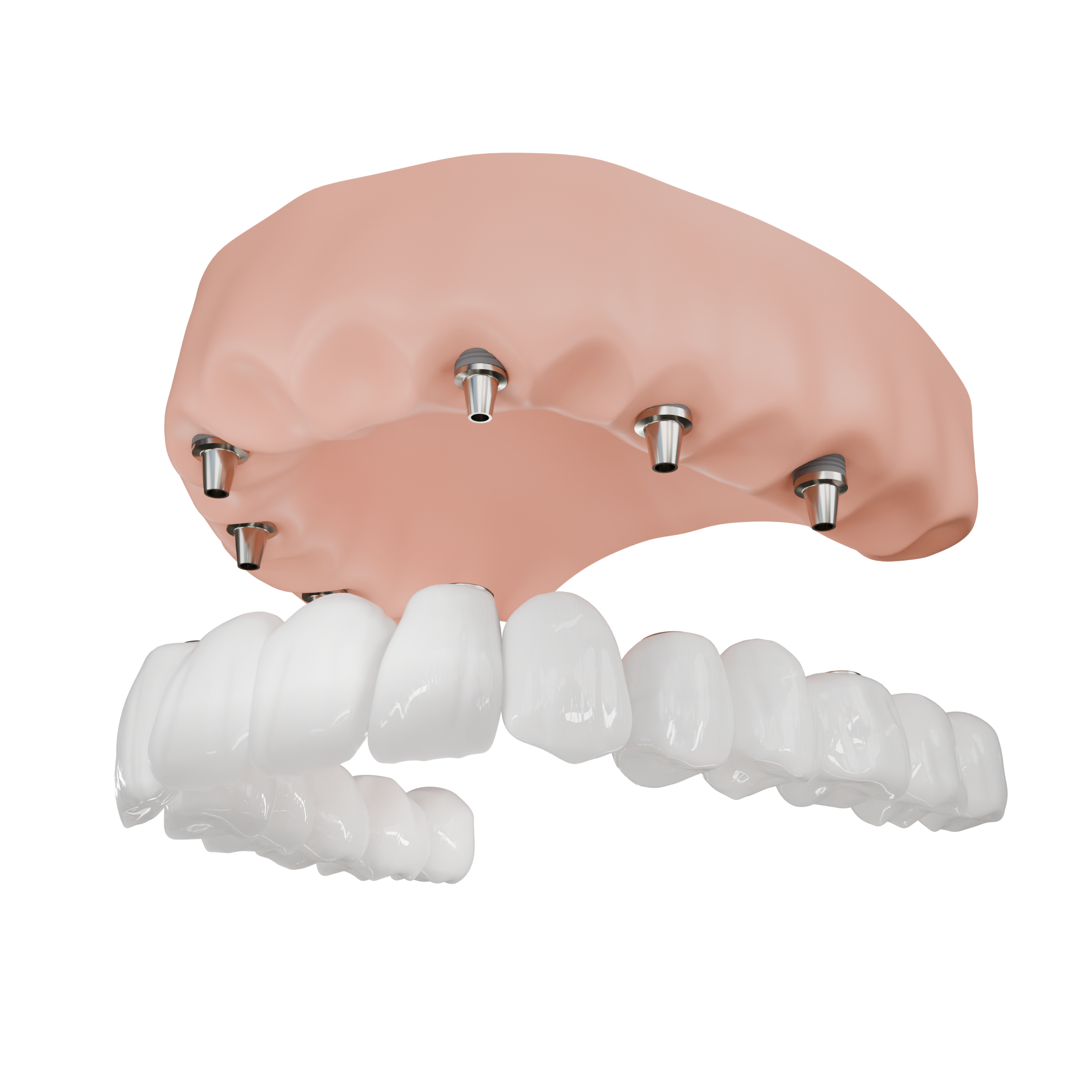 Full Arch Reconstruction - Back View